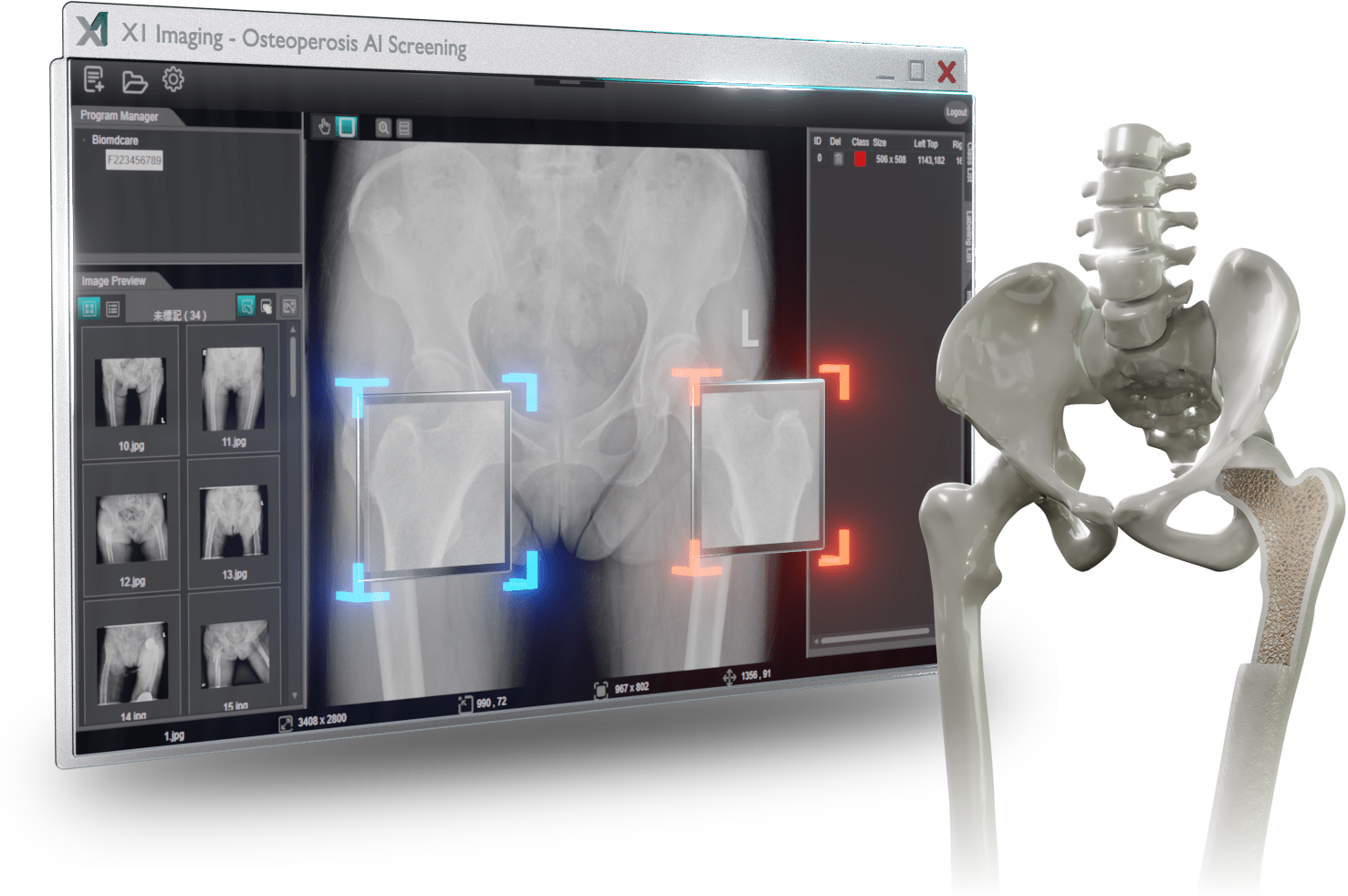 Osteoporosis AI Screening Assistant